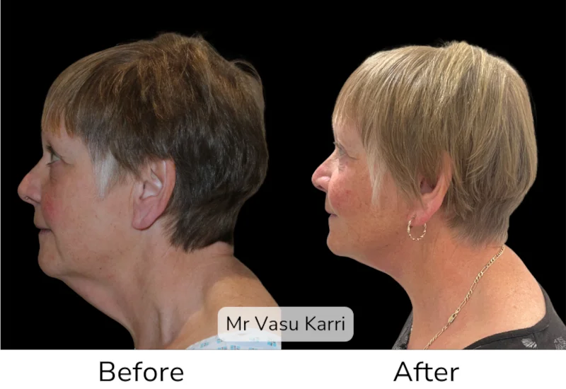 Facelift Patient 12 View 2